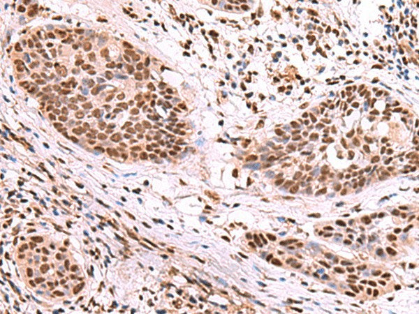 Immunohistochemistry of paraffin-embedded Human esophagus cancer tissue using SF3B3 Polyclonal Antibody at dilution of 1:70(×200)
