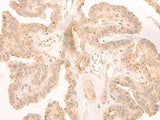 Immunohistochemistry of paraffin-embedded Human thyroid cancer tissue using LCMT2 Polyclonal Antibody at dilution of 1:45(×200)