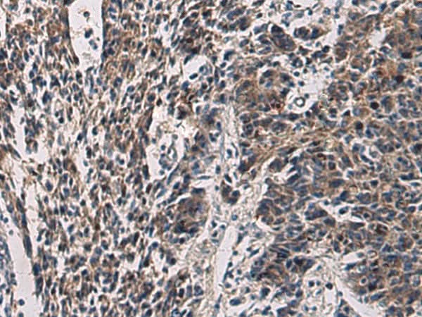 Immunohistochemistry of paraffin-embedded Human colorectal cancer tissue using CCNI Polyclonal Antibody at dilution of 1:60(×200)