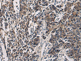 Immunohistochemistry of paraffin-embedded Human colorectal cancer tissue using CCNI Polyclonal Antibody at dilution of 1:60(×200)