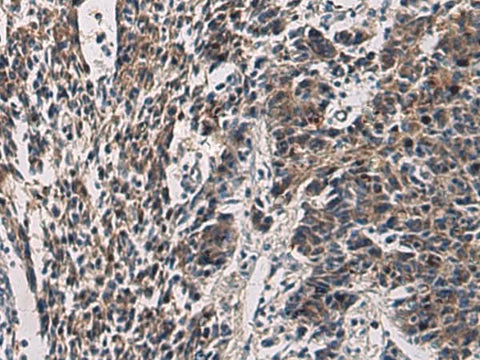 Immunohistochemistry of paraffin-embedded Human colorectal cancer tissue using CCNI Polyclonal Antibody at dilution of 1:60(×200)