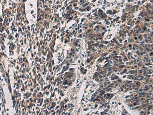 Immunohistochemistry of paraffin-embedded Human colorectal cancer tissue using CCNI Polyclonal Antibody at dilution of 1:60(×200)