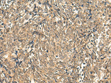Immunohistochemistry of paraffin-embedded Human lung cancer tissue using HNF1A Polyclonal Antibody at dilution of 1:50(×200)