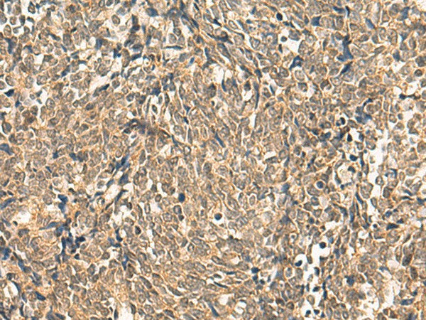 Immunohistochemistry of paraffin-embedded Human lung cancer tissue using HNF1A Polyclonal Antibody at dilution of 1:50(×200)