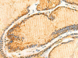 Immunohistochemistry of paraffin-embedded Human thyroid cancer tissue using ZNF581 Polyclonal Antibody at dilution of 1:50(×200)