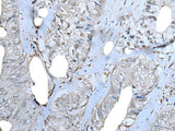 Immunohistochemistry of paraffin-embedded Human colorectal cancer tissue using ZNF703 Polyclonal Antibody at dilution of 1:40(×200)