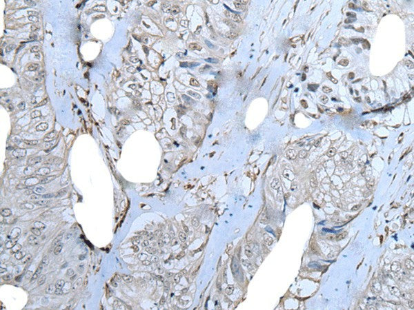 Immunohistochemistry of paraffin-embedded Human colorectal cancer tissue using ZNF703 Polyclonal Antibody at dilution of 1:40(×200)