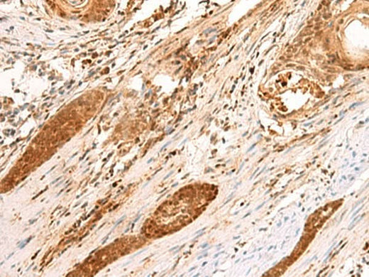 Immunohistochemistry of paraffin-embedded Human esophagus cancer tissue using SCAND1 Polyclonal Antibody at dilution of 1:90(×200)
