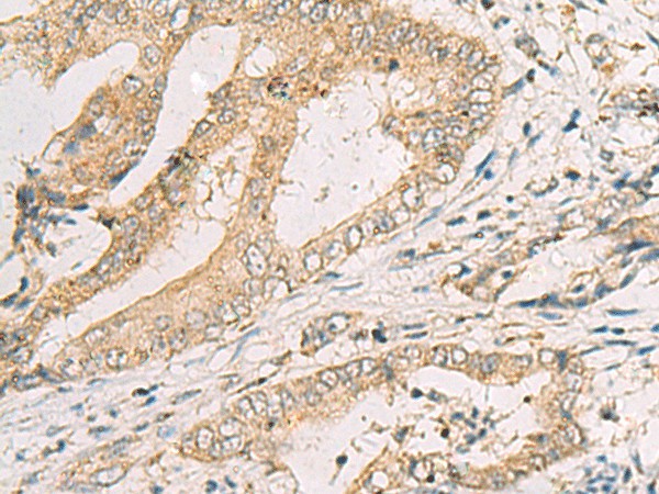 Immunohistochemistry of paraffin-embedded Human cervical cancer tissue using SPACA1 Polyclonal Antibody at dilution of 1:50(×200)