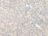 Immunohistochemistry of paraffin-embedded Human cervical cancer tissue using RADIL Polyclonal Antibody at dilution of 1:40(×200)
