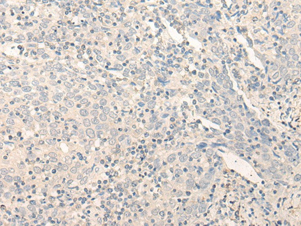 Immunohistochemistry of paraffin-embedded Human cervical cancer tissue using RADIL Polyclonal Antibody at dilution of 1:40(×200)