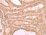 Immunohistochemistry of paraffin-embedded Human thyroid cancer tissue using CDC20 Polyclonal Antibody at dilution of 1:70(×200)