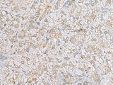 Immunohistochemistry of paraffin-embedded Human liver cancer tissue using LRRC49 Polyclonal Antibody at dilution of 1:40(×200)