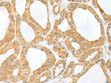 Immunohistochemistry of paraffin-embedded Human thyroid cancer tissue using PPIH Polyclonal Antibody at dilution of 1:60(×200)