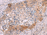Immunohistochemistry of paraffin-embedded Human cervical cancer tissue using GRIK4 Polyclonal Antibody at dilution of 1:50(×200)