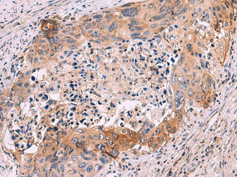 Immunohistochemistry of paraffin-embedded Human cervical cancer tissue using GRIK4 Polyclonal Antibody at dilution of 1:50(×200)