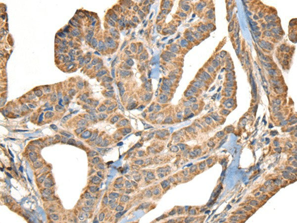 Immunohistochemistry of paraffin-embedded Human thyroid cancer tissue using SLAMF7 Polyclonal Antibody at dilution of 1:30(×200)