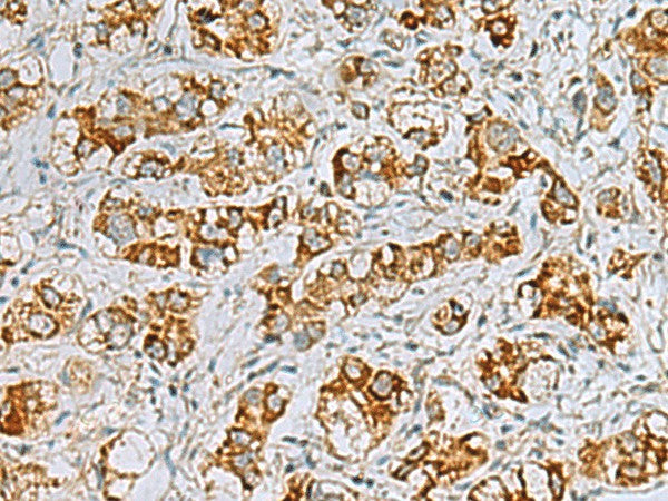 Immunohistochemistry of paraffin-embedded Human liver cancer tissue using FAAP100 Polyclonal Antibody at dilution of 1:40(×200)