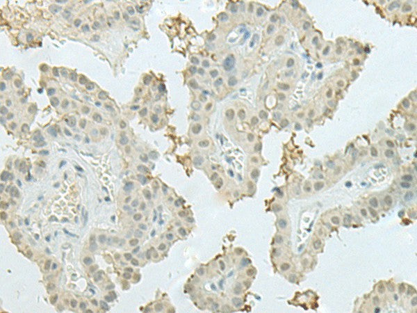 Immunohistochemistry of paraffin-embedded Human thyroid cancer tissue using MECOM Polyclonal Antibody at dilution of 1:60(×200)