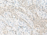Immunohistochemistry of paraffin-embedded Human ovarian cancer tissue using HABP4 Polyclonal Antibody at dilution of 1:60(×200)