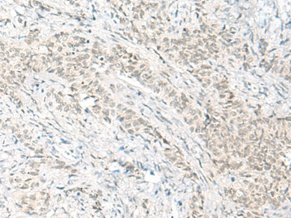 Immunohistochemistry of paraffin-embedded Human ovarian cancer tissue using HABP4 Polyclonal Antibody at dilution of 1:60(×200)