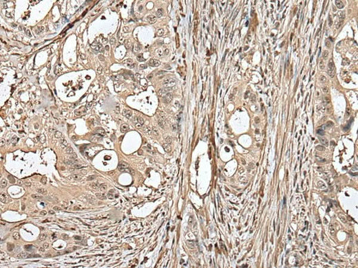 Immunohistochemistry of paraffin-embedded Human colorectal cancer tissue using UTP3 Polyclonal Antibody at dilution of 1:50(×200)