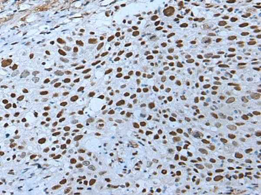 Immunohistochemistry of paraffin-embedded Human lung cancer tissue using ZNHIT3 Polyclonal Antibody at dilution of 1:80(×200)