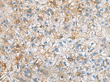 Immunohistochemistry of paraffin-embedded Human liver cancer tissue using IGLL1 Polyclonal Antibody at dilution of 1:50(×200)