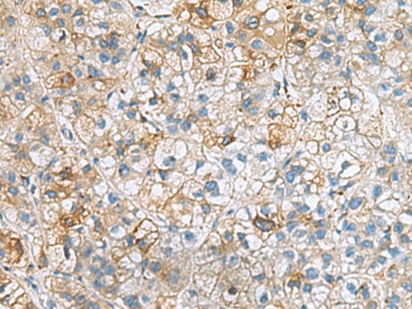 Immunohistochemistry of paraffin-embedded Human liver cancer tissue using IGLL1 Polyclonal Antibody at dilution of 1:50(×200)