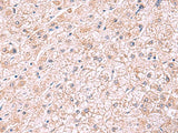 Immunohistochemistry of paraffin-embedded Human liver cancer tissue using PDRG1 Polyclonal Antibody at dilution of 1:75(×200)