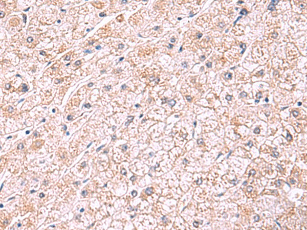 Immunohistochemistry of paraffin-embedded Human liver cancer tissue using PDRG1 Polyclonal Antibody at dilution of 1:75(×200)