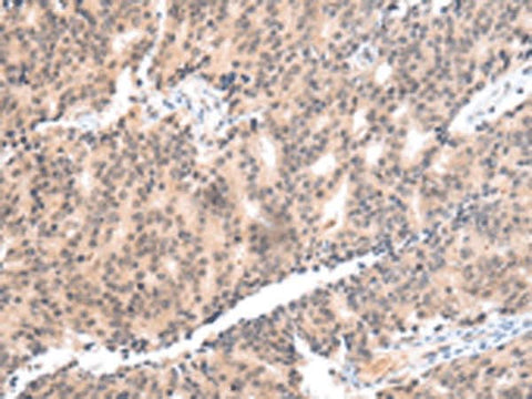 Immunohistochemistry of paraffin-embedded Human prost at e cancer tissue using COX17 Polyclonal Antibody at dilution of 1:55(×200)