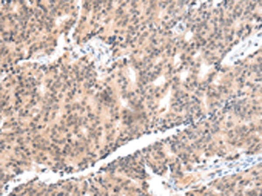 Immunohistochemistry of paraffin-embedded Human prost at e cancer tissue using COX17 Polyclonal Antibody at dilution of 1:55(×200)