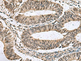 Immunohistochemistry of paraffin-embedded Human colorectal cancer tissue using TMX3 Polyclonal Antibody at dilution of 1:70(×200)