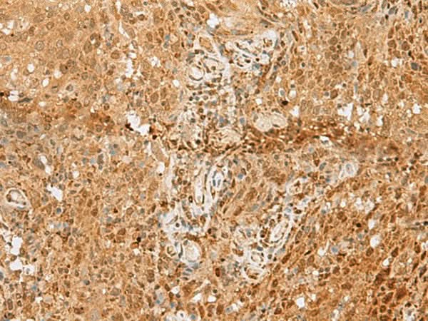 Immunohistochemistry of paraffin-embedded Human cervical cancer tissue using PNRC2 Polyclonal Antibody at dilution of 1:50(×200)