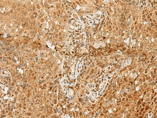 Immunohistochemistry of paraffin-embedded Human cervical cancer tissue using PNRC2 Polyclonal Antibody at dilution of 1:50(×200)