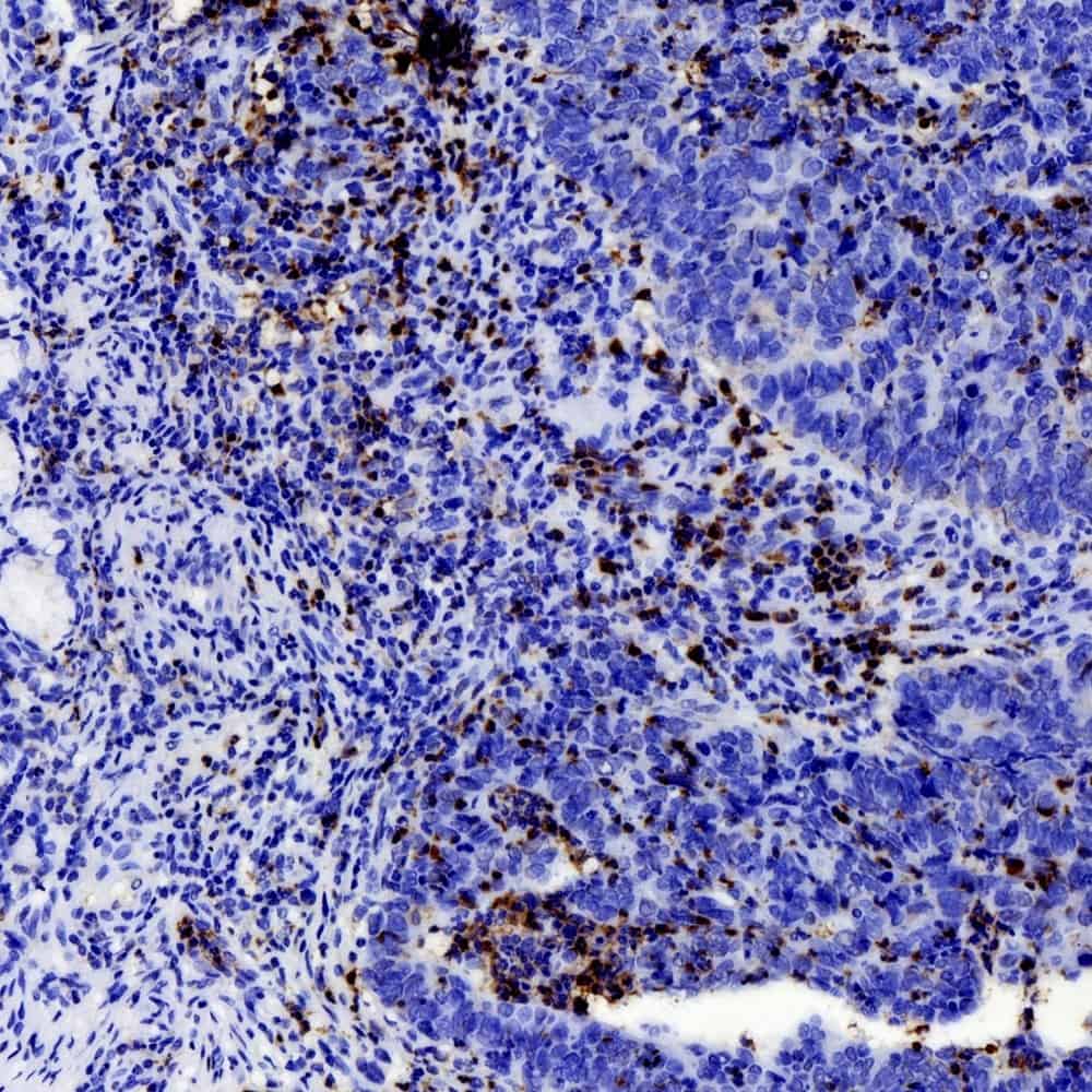 Immunohistochemistry analysis of paraffin-embedded human stomach cancer using MMP9 Polyclonal Antibody at dilution of 1:200.