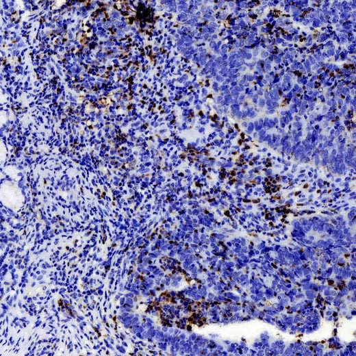 Immunohistochemistry analysis of paraffin-embedded human stomach cancer using MMP9 Polyclonal Antibody at dilution of 1:200.
