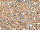 Immunohistochemistry of paraffin-embedded Human liver cancer tissue using C5AR1 Polyclonal Antibody at dilution of 1:50(×200)