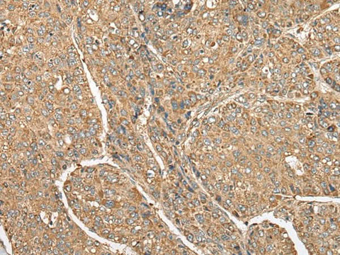 Immunohistochemistry of paraffin-embedded Human liver cancer tissue using C5AR1 Polyclonal Antibody at dilution of 1:50(×200)