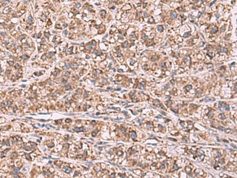 Immunohistochemistry of paraffin-embedded Human liver cancer tissue using GUSB Polyclonal Antibody at dilution of 1:75(×200)