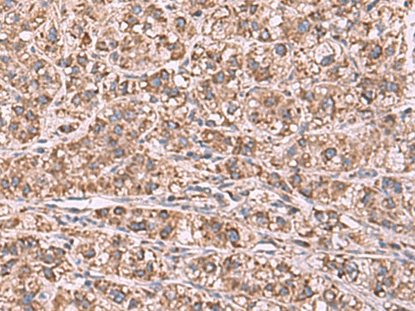 Immunohistochemistry of paraffin-embedded Human liver cancer tissue using GUSB Polyclonal Antibody at dilution of 1:75(×200)