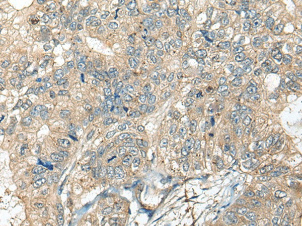 Immunohistochemistry of paraffin-embedded Human gastric cancer tissue using CASR Polyclonal Antibody at dilution of 1:60(×200)