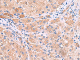 Immunohistochemistry of paraffin-embedded Human liver cancer tissue using MPP1 Polyclonal Antibody at dilution of 1:50(×200)