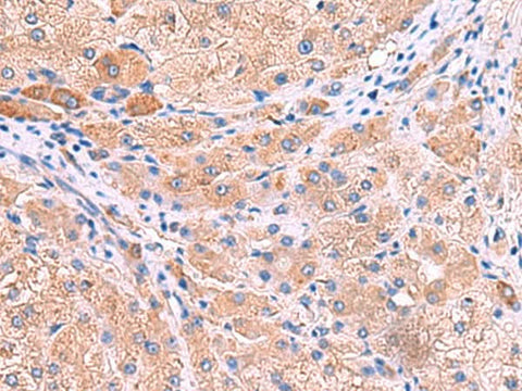 Immunohistochemistry of paraffin-embedded Human liver cancer tissue using MPP1 Polyclonal Antibody at dilution of 1:50(×200)