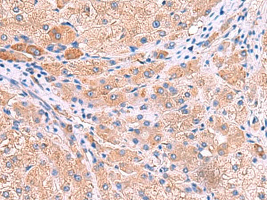 Immunohistochemistry of paraffin-embedded Human liver cancer tissue using MPP1 Polyclonal Antibody at dilution of 1:50(×200)