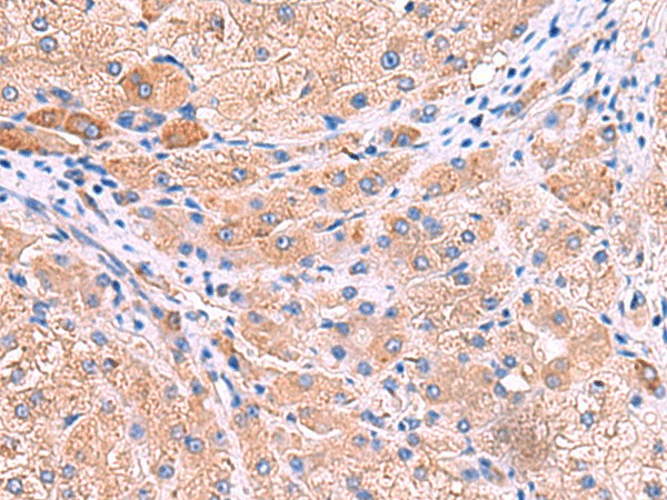 Immunohistochemistry of paraffin-embedded Human liver cancer tissue using MPP1 Polyclonal Antibody at dilution of 1:50(×200)
