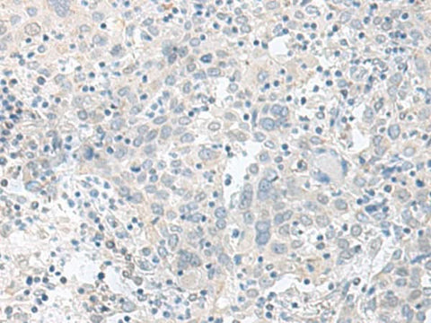 Immunohistochemistry of paraffin-embedded Human cervical cancer tissue using TIMM8A Polyclonal Antibody at dilution of 1:90(×200)