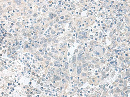 Immunohistochemistry of paraffin-embedded Human cervical cancer tissue using TIMM8A Polyclonal Antibody at dilution of 1:90(×200)
