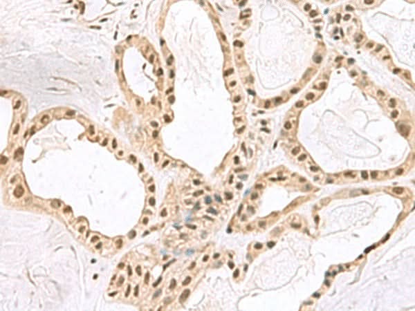 Immunohistochemistry of paraffin-embedded Human thyroid cancer tissue using PCLAF Polyclonal Antibody at dilution of 1:60(×200)
